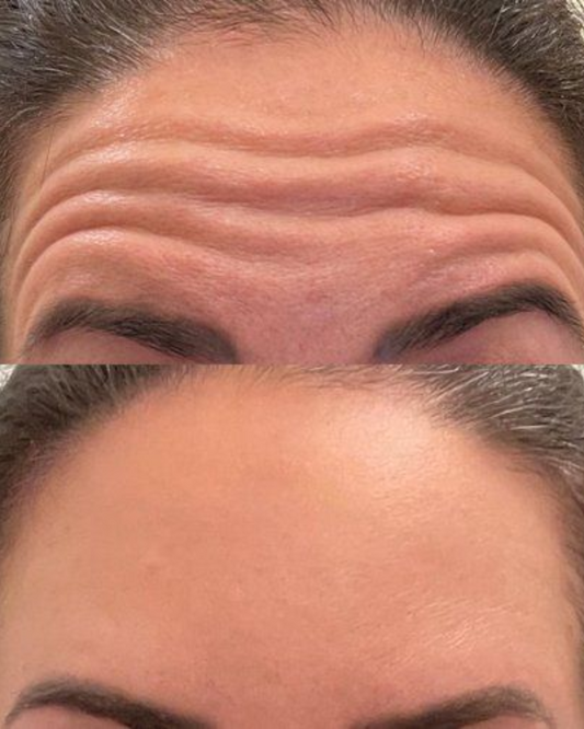 Rides du front : comment réduire leur apparence ?