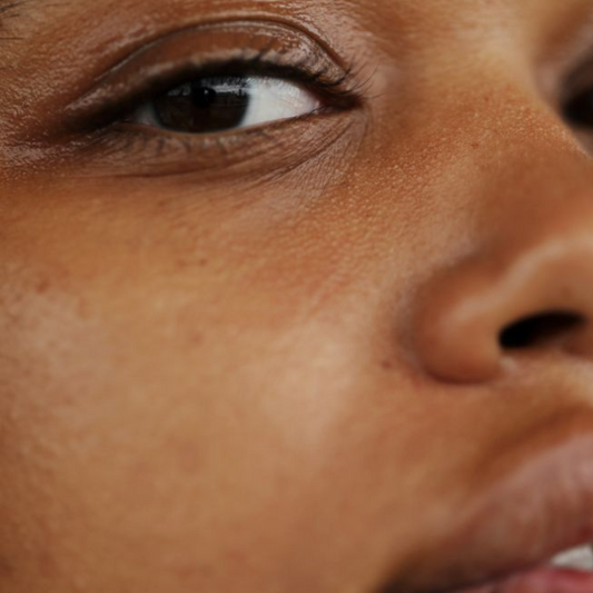 Qu'est-ce que la dysséborrhée ?