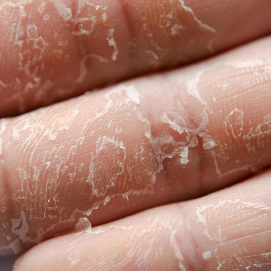 Peau qui pèle : pourquoi et comment l'éviter ?