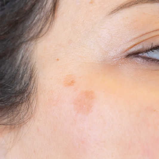 Qu'est-ce que l'hyperpigmentation ?