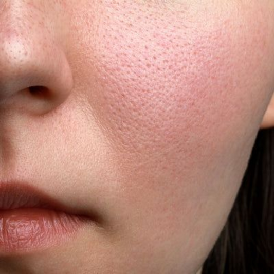 Quelles sont les causes de la dilatation des pores ?