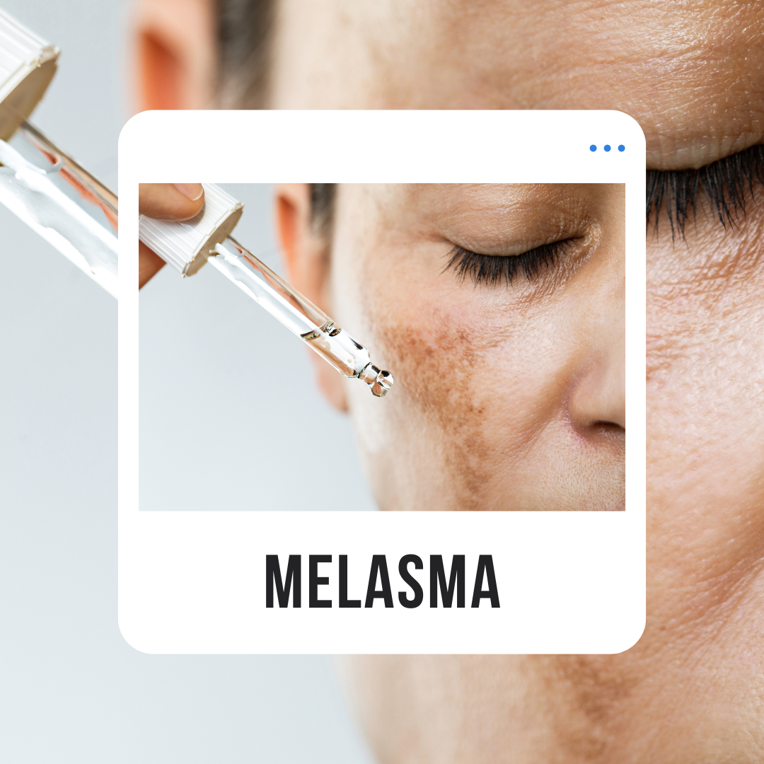 Quelles sont les causes d'un mélasma ?