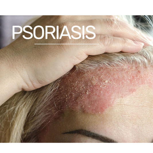 How does psoriasis start?