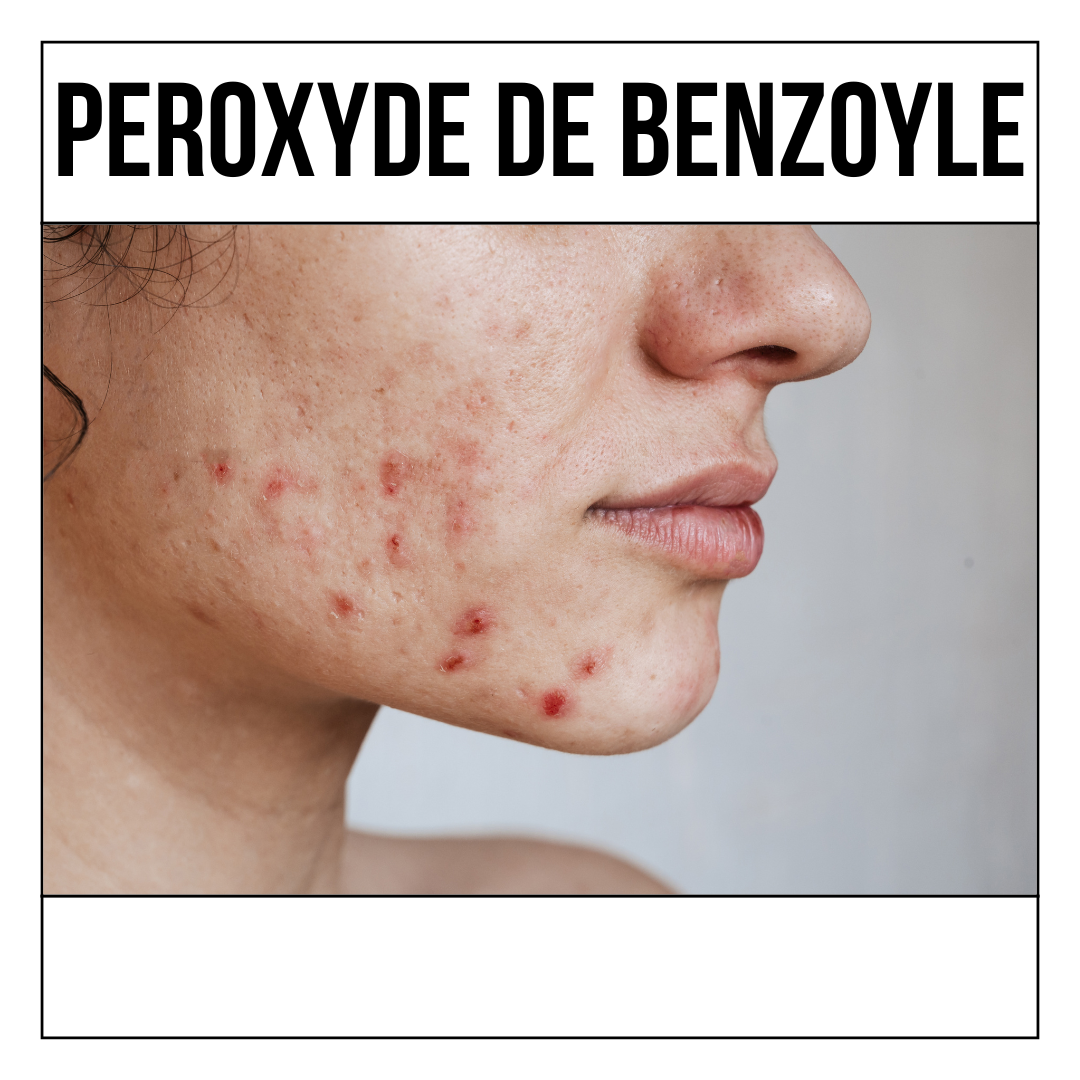 Blemished skin: what is benzoyl peroxide?
