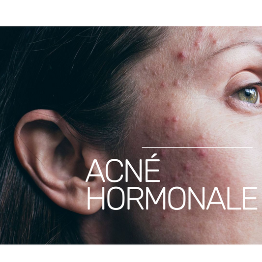 What are the 3 main factors in hormonal acne?