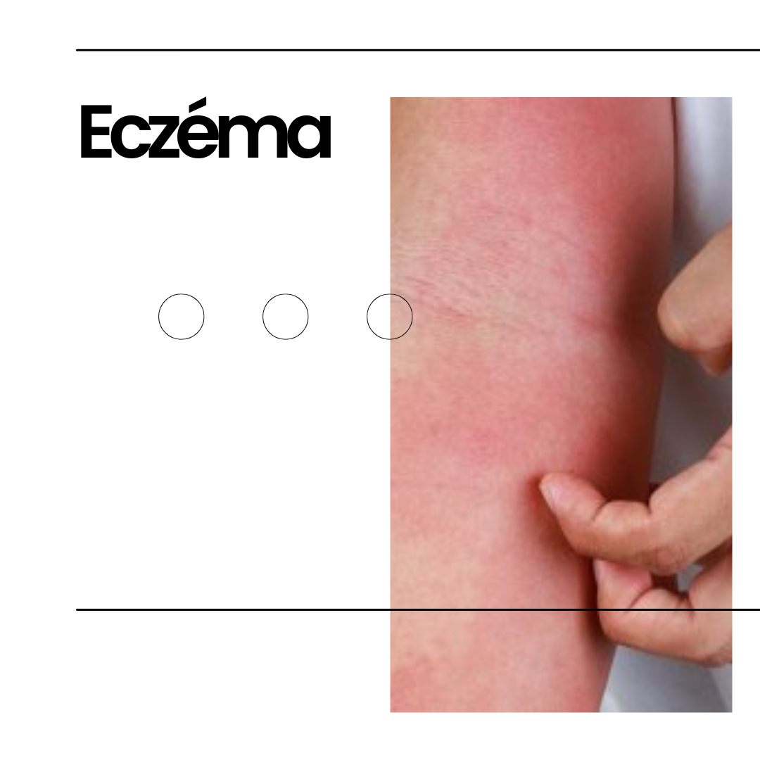 Which product to use to relieve eczema?