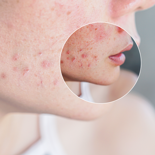 How do I know what type of acne I have?
