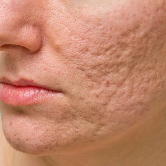 Acne scars: how to get rid of them effectively?
