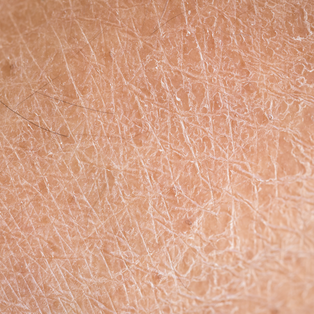 What causes dry skin?