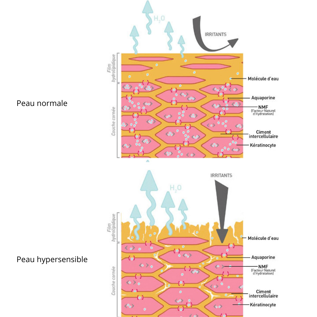 Skin hypersensitivity - symptoms, causes and treatment