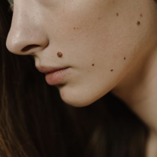 What causes moles and how can they be monitored?
