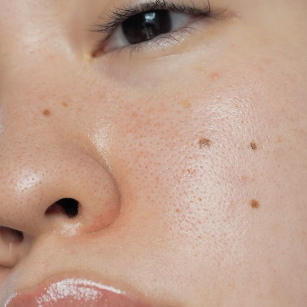 Why do we get more moles as we age?