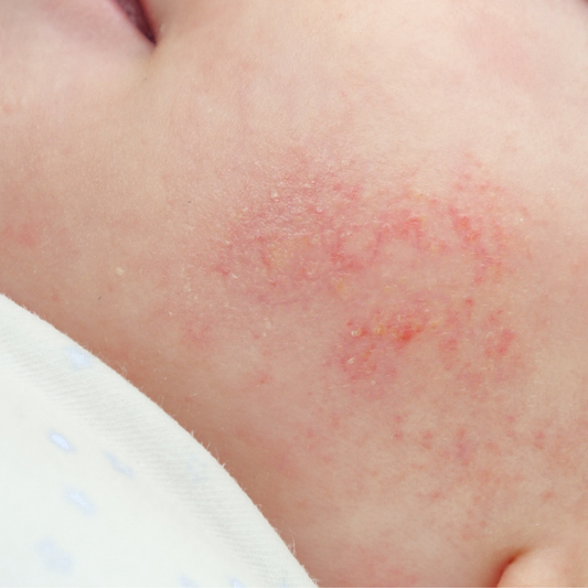 What are atopic diseases?