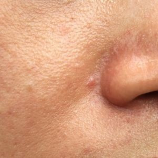 How to treat granular skin