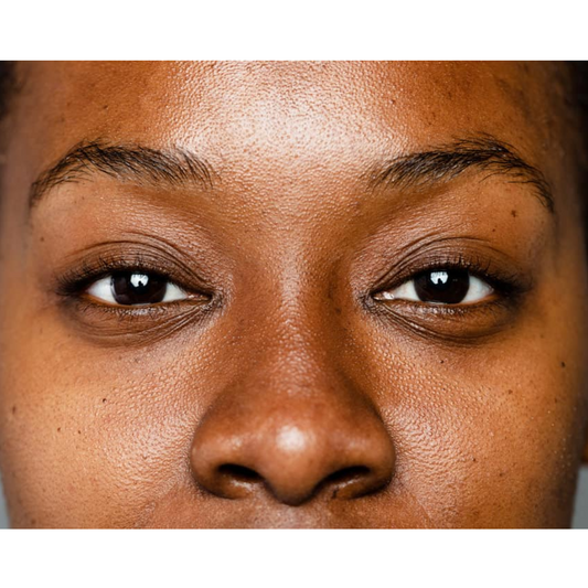 What causes hyperpigmentation?