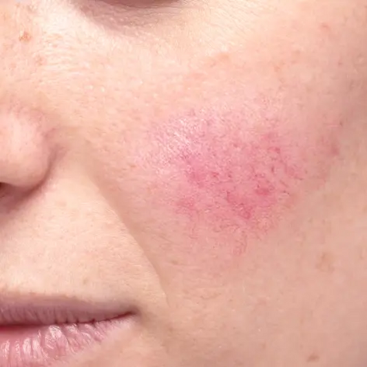 How to get rid of acne rosacea?