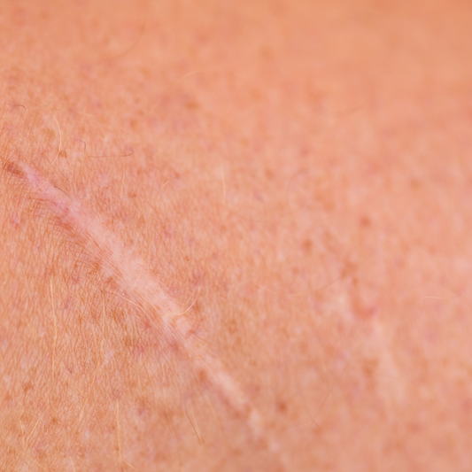 How do I treat a scar?