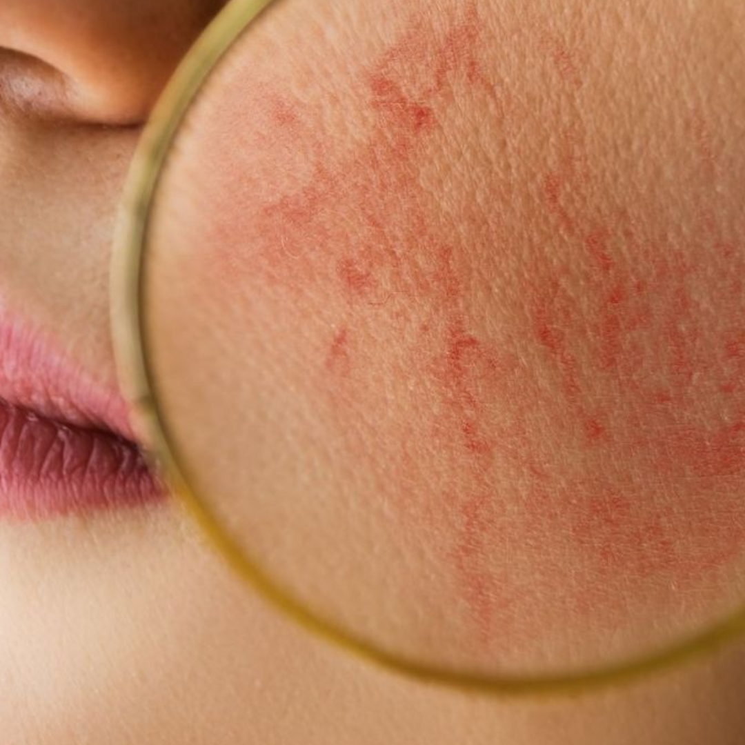Rosacea: can bakuchiol reduce redness?