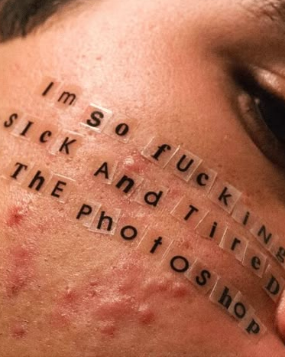 Acne pimples: how do you get rid of them?