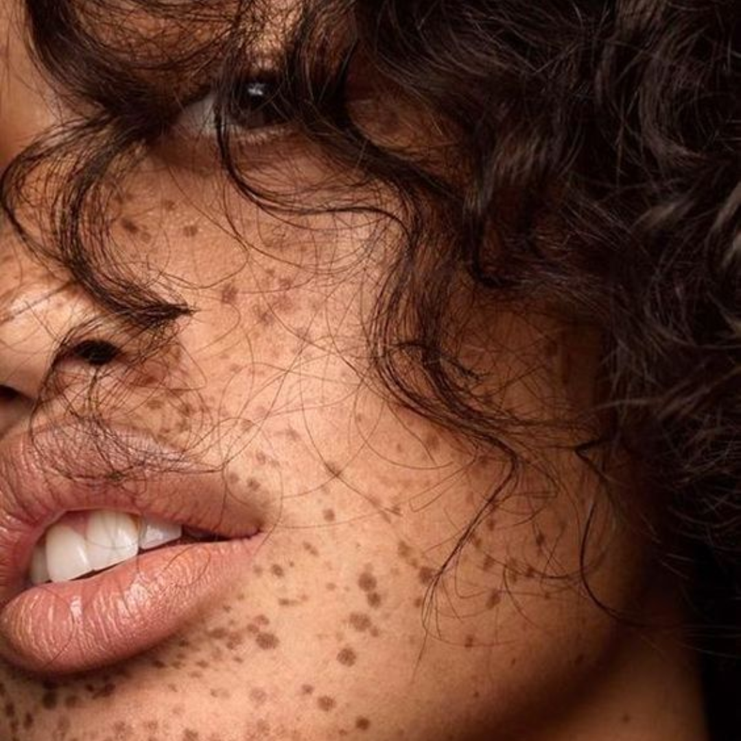 Why do freckles appear? Decoding