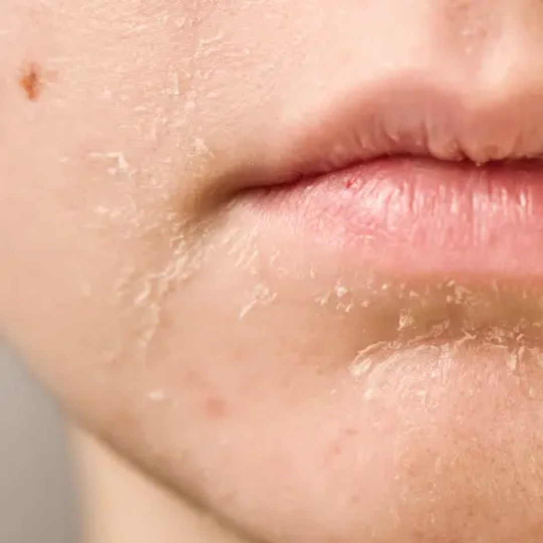 How to moisturize very dry facial skin?
