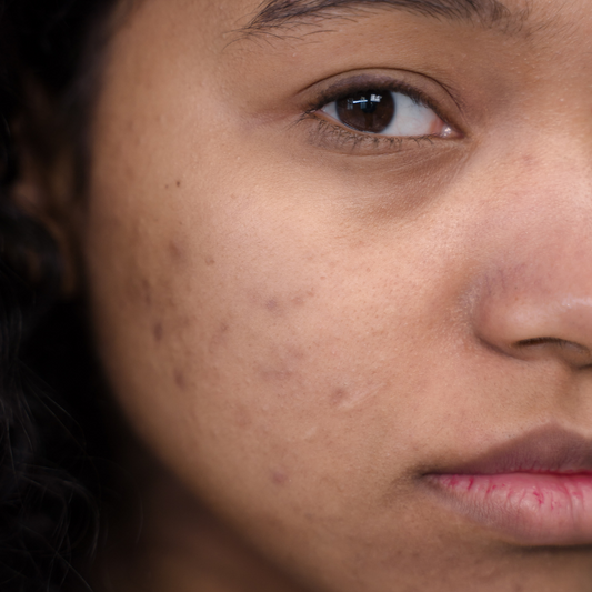 Hyperpigmentation of black and mixed-race skin