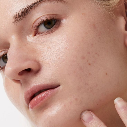 What are the different types of acne?