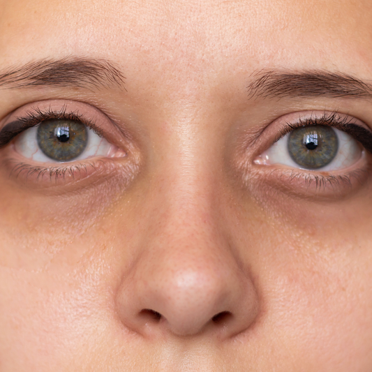 Causes of dark circles under the eyes