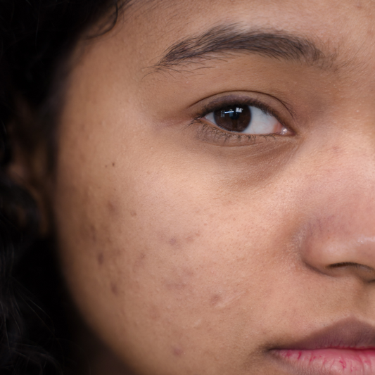 Skin with imperfections | beauty steps to take