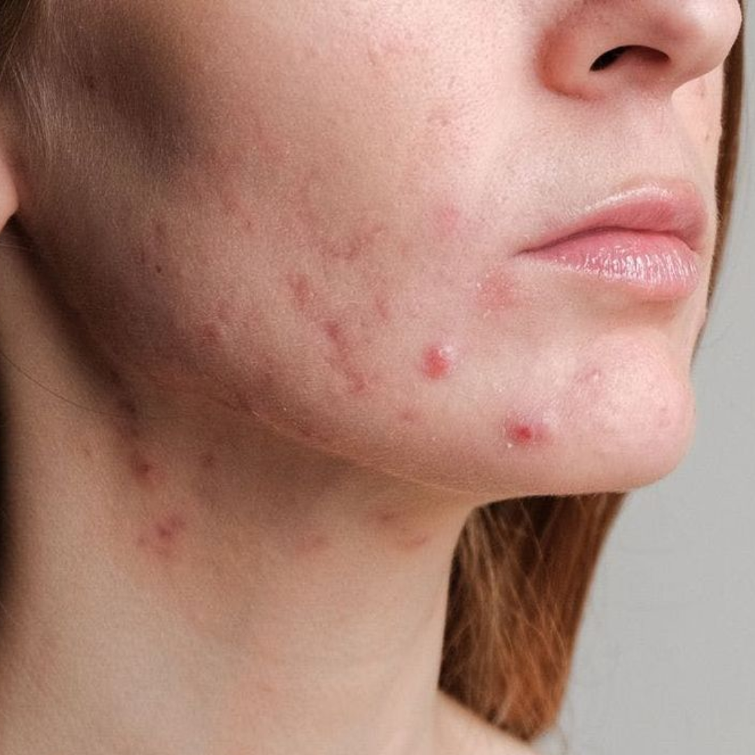 ¿Cómo puedo saber si se trata de acné hormonal?