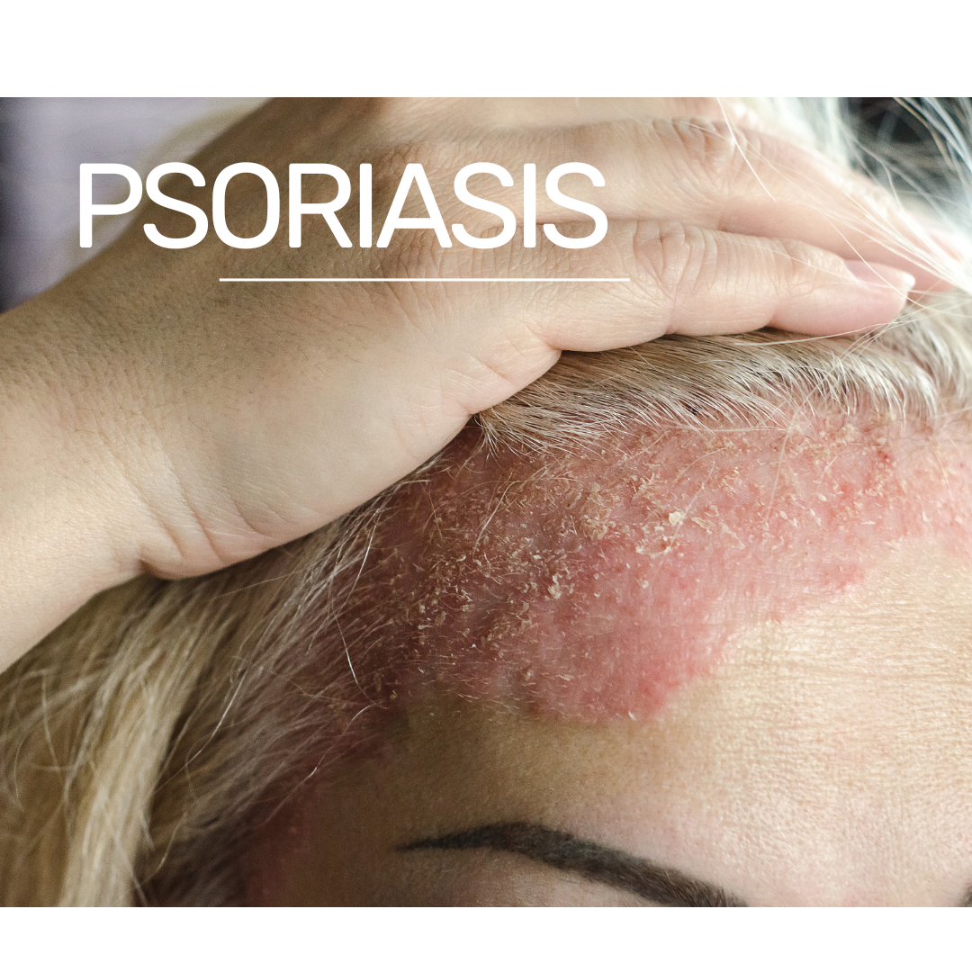 Comment se déclenche le psoriasis ?