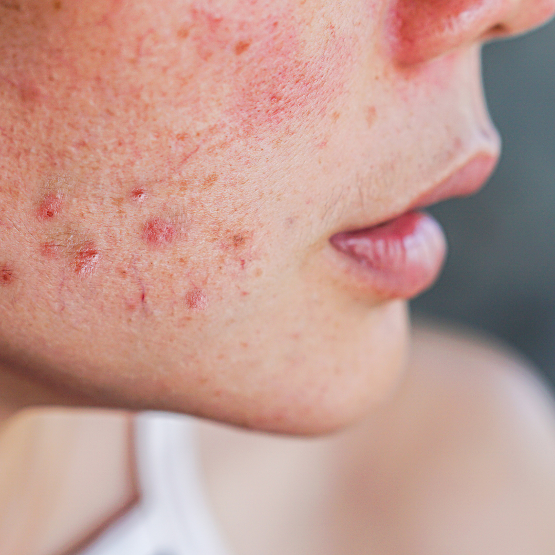 Comment savoir si mon acné est hormonale | causes et traitement