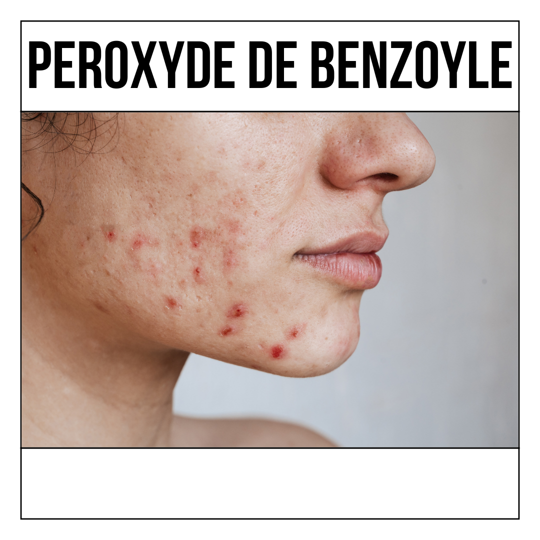 Peau à imperfections : qu'est-ce que le peroxyde de benzoyle ?