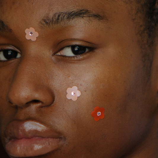 How can you treat adult acne without making wrinkles worse?