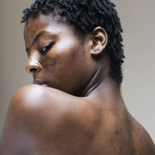 What makes you get more acne?