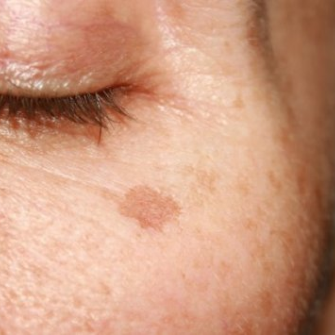 Comment se débarrasser des taches brunes sur le visage ?