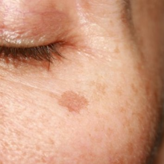 Comment se débarrasser des taches brunes sur le visage ?