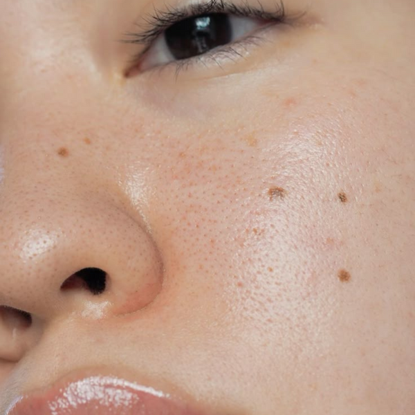 Pourquoi avons-nous plus de grains de beauté avec l’âge ?