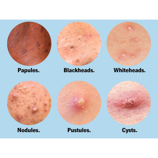 Quels ingrédients et crèmes efficaces anti boutons ?