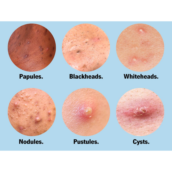 Quels ingrédients et crèmes efficaces anti boutons ?