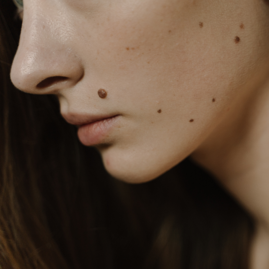 Quelle est la cause des grains de beauté et comment les surveiller ?