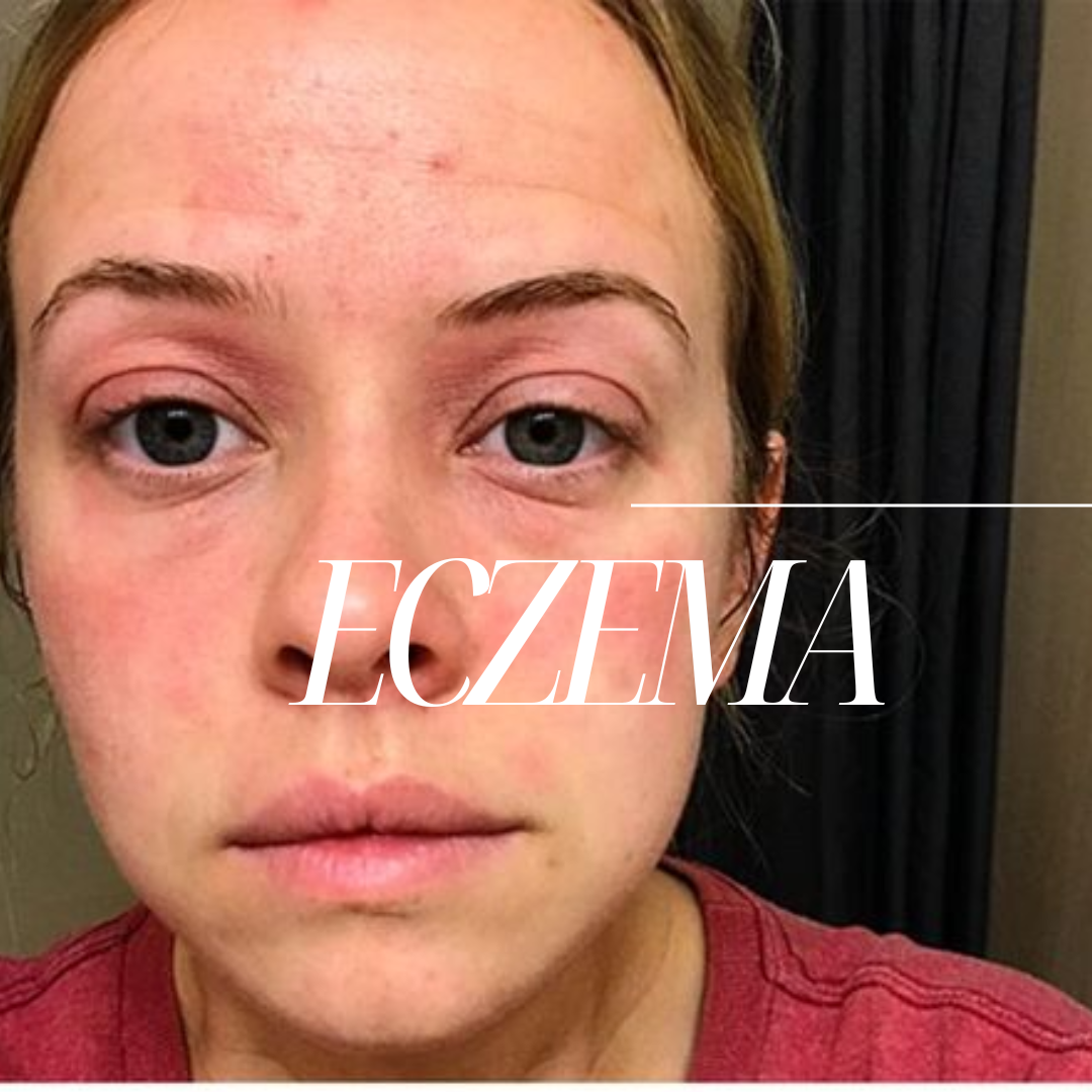 Quelles sont les causes de l'eczema ?
