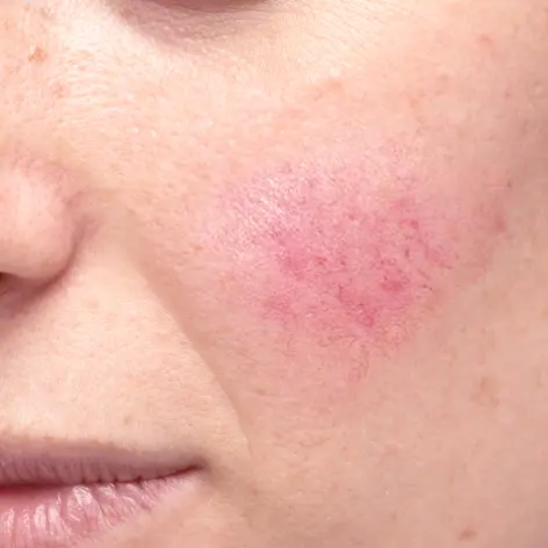 Comment se débarrasser de l'acné rosacée ?