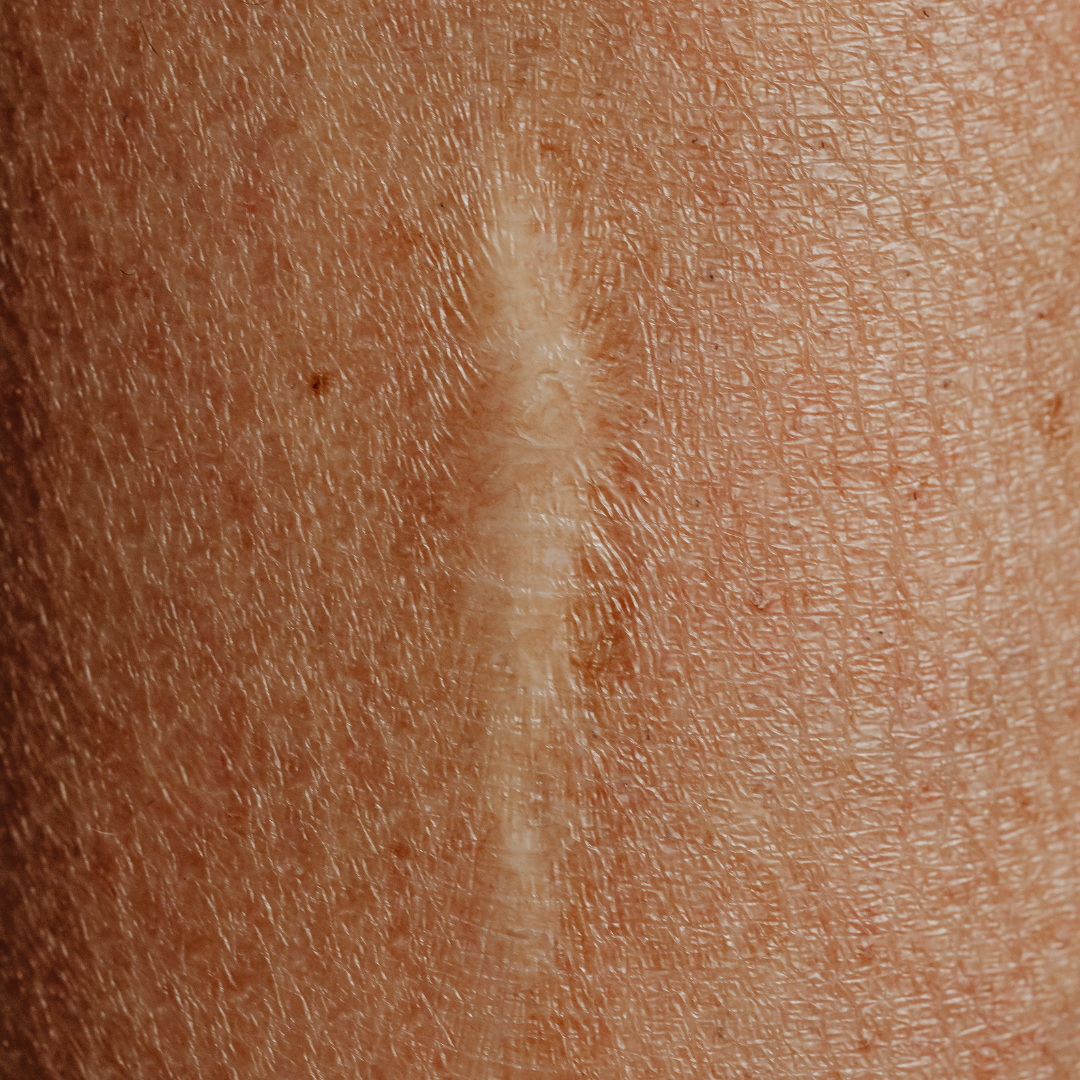 Cicatrice : comment faire pour les atténuer ?