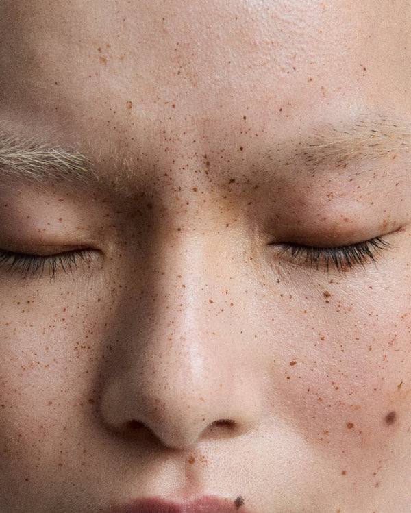 Comédons, papules, pustules : comprendre les différents types de boutons pour mieux les éviter