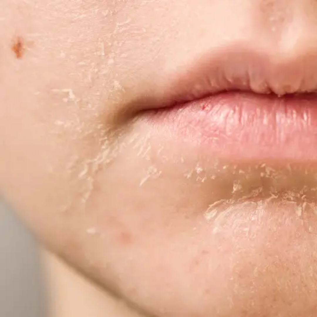 Comment hydrater la peau du visage très sèche ?