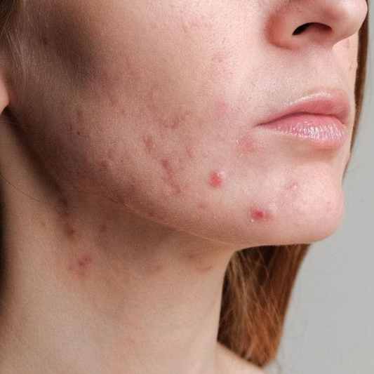 Comment savoir si c'est de l'acné hormonale ?