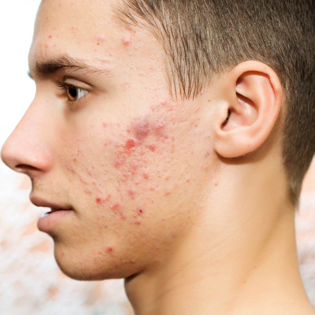 Peau acnéique | causes, traitement et soins