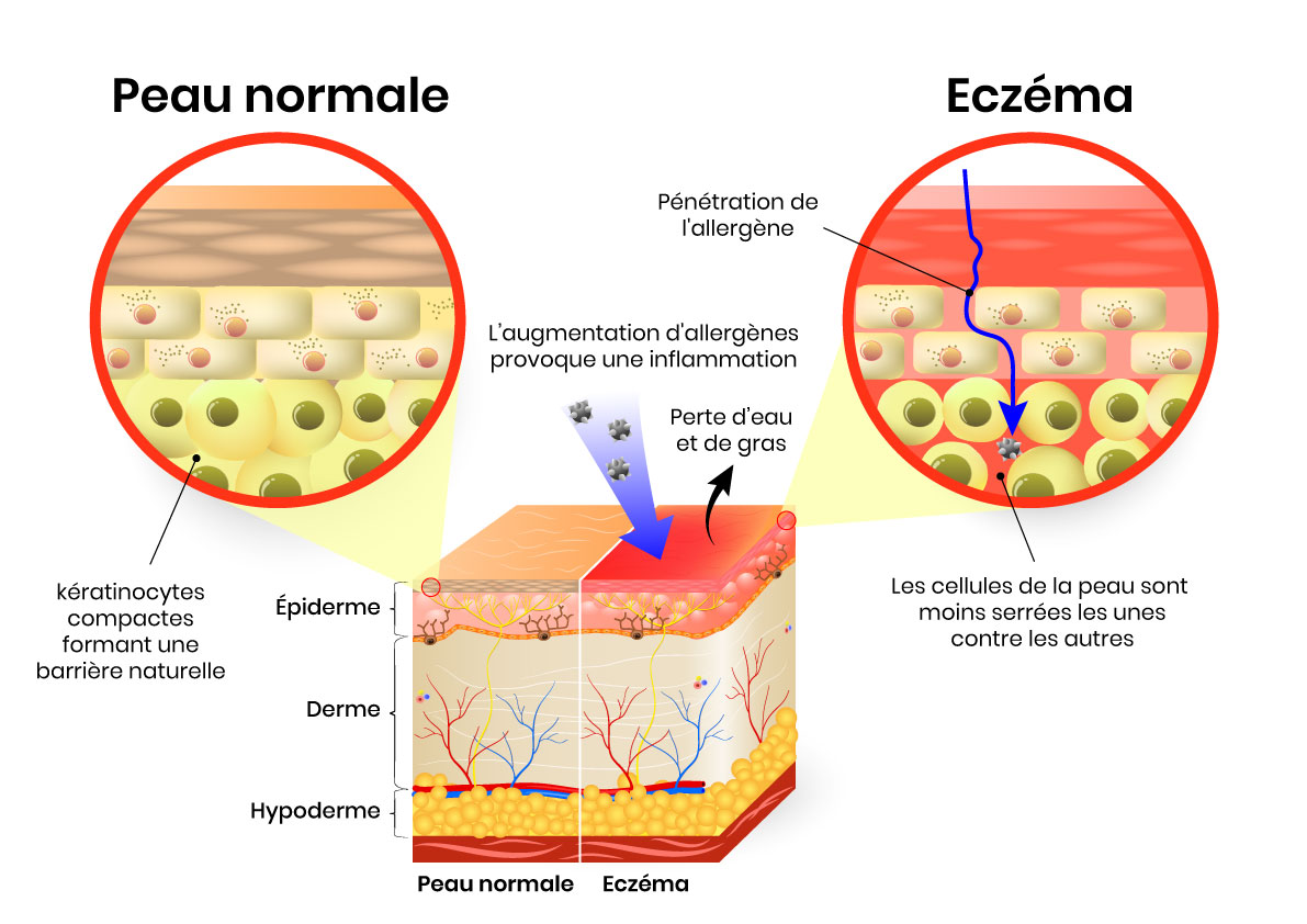 Dermatite atopique | symptômes, causes, traitement