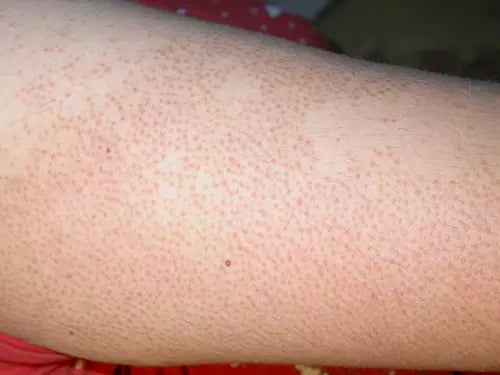 Peau rugueuse granuleuse | causes et comment s'en débarasser